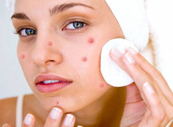 cách chăm sóc da mặt bị mụn hiệu quả